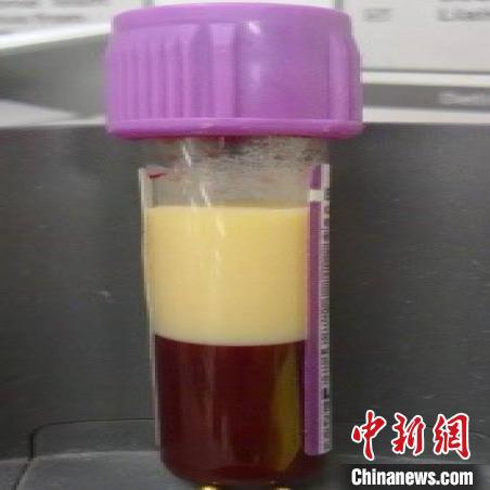 广州一男子每天喝奶茶却暴瘦20多斤？专家：可能酮酸症中毒